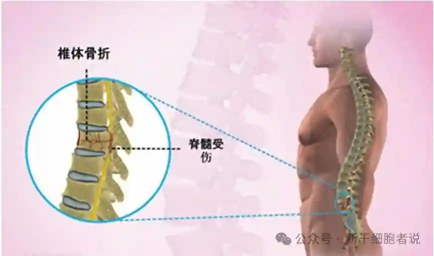 世界第一款细胞治疗产品OPC1治疗脊髓损伤的来龙去脉