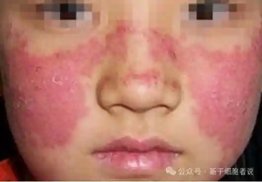 降伏“致命恶魔”红斑狼疮的新武器——干细胞