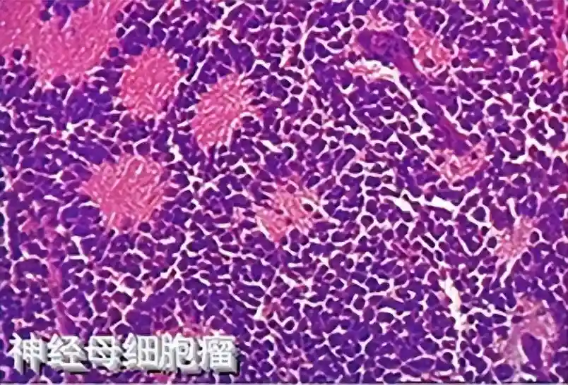 神经母细胞瘤患者治疗新选择！创新药依氟鸟氨酸落地乐城博鳌未来医院