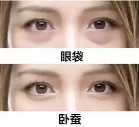 卧蚕VS.眼袋，眼睑下的哪种脂肪才能给妳带来真正的快乐？