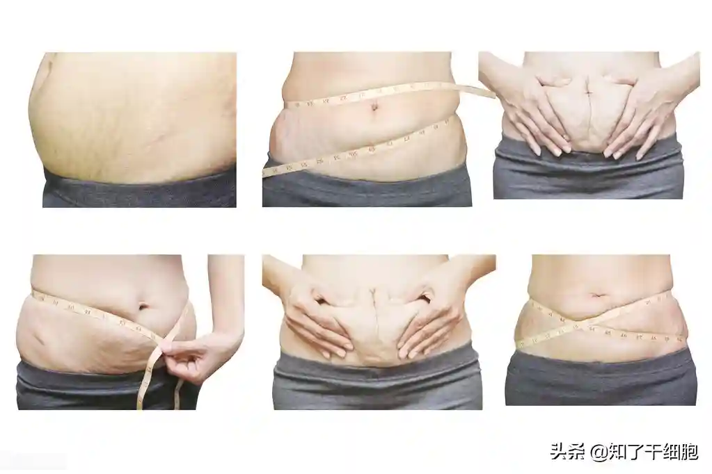 越年轻越不容易长妊娠纹？不对