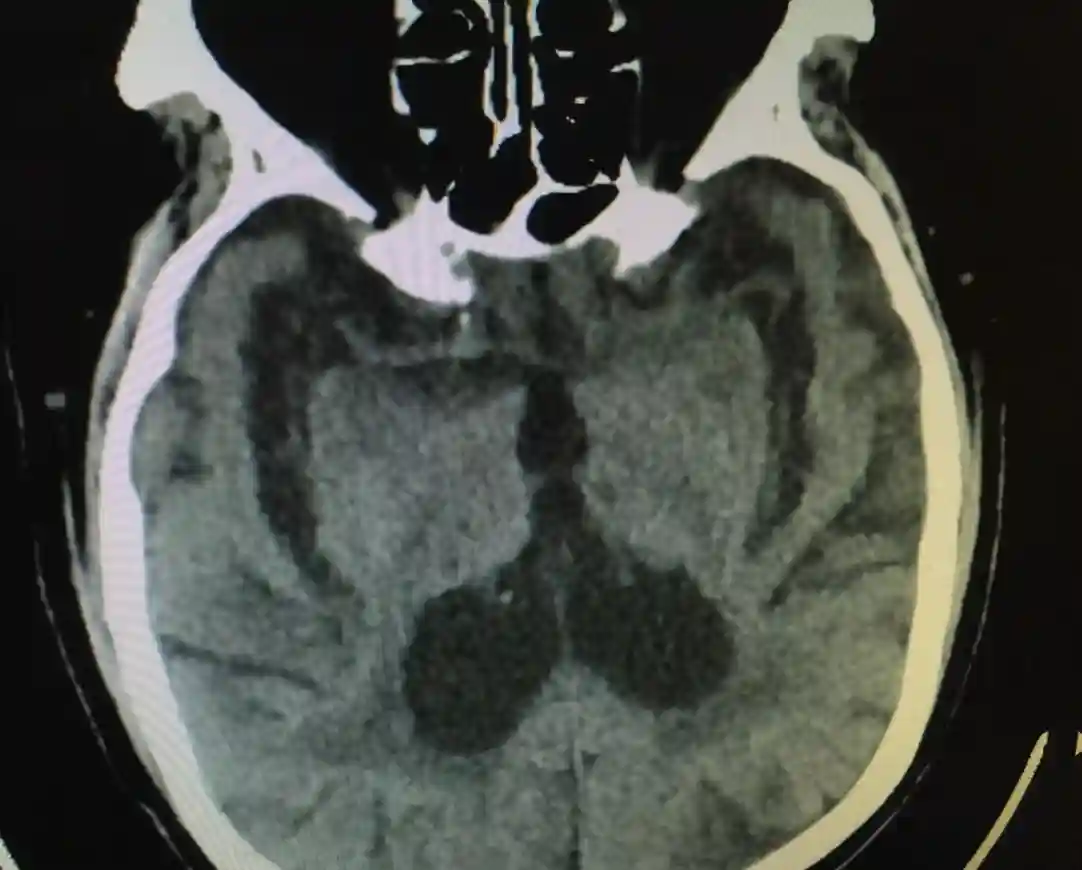 脑萎缩一般多大年龄发生？该怎么预防？
