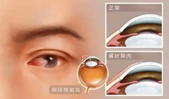 眼睛也要防晒？！忽视它导致黑眼球长出“小红肉”
